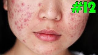 How to Get Rid of Blackheads amp Whiteheads on The Face Easy  Acne Treatmen 12 [upl. by Arayt]