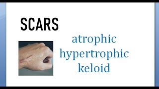 Surgery 015 Scars Atrophic hypertrophic keloid difference compare between vs wound [upl. by Laurena]