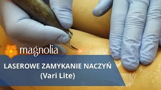 Vari Lite laserowe zamykanie naczyń Klinika Magnolia Łódź [upl. by Euqinorev515]