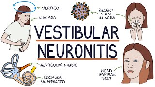 Understanding Vestibular Neuronitis [upl. by Curkell]