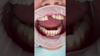 Dental bridge procedure  dental bridge front teeth  dental bridge before and after  Dr Yazdan [upl. by Risser]