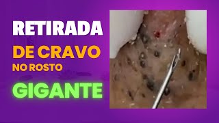 Cravos pretos profundos e gigantes  Tirando cravos e EspinhasVIDEO SATISFATÓRIO E RELAXANTE 02 [upl. by Ahteral]