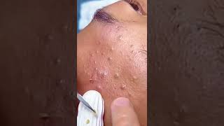 Huge Blackhead Extraction Extremely Satisfying [upl. by Eldoria]