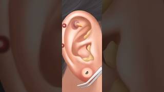 Ear Cleaning ASMR  ASMR  Ear wax removal asmr earcleaning [upl. by Celestyna]