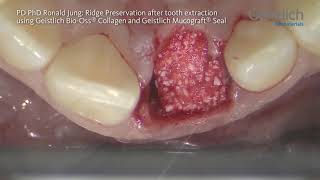 PD PhD Ronald Jung Ridge Preservation after Tooth Extraction using Geistlich Mucograft® Seal [upl. by Laina]