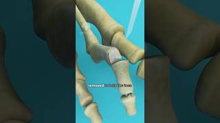 What is Hammer Toe and How to Fix It shorts viralvideo  Creativelearning3d [upl. by Onitsuaf554]