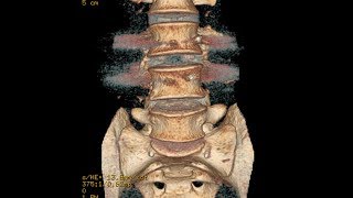 A Case of Double Failed Lumbar Fusion and Dangerously Misplaced Pedicle Screws [upl. by Combs]