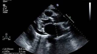 EchoWeb  Aortic Stenosis and Pericardial Effusion [upl. by Anerb]