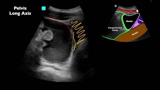 POCUS Positive EFAST after MVC  Can you identify all of the findings [upl. by Suixela]