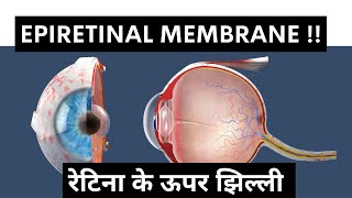 Retina पर झिल्ली  क्या है Epiretinal Membrane ERM [upl. by Dirk]