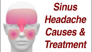 Sinus Headaches Causes amp Treatment [upl. by Amalbena]