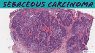 Sebaceous carcinoma 5Minute Pathology Pearls [upl. by Yehs]