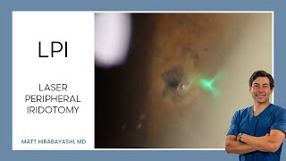 LPI Laser Peripheral Iridotomy [upl. by Naitsirk]