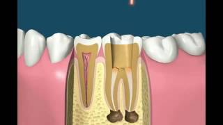 Root canal treatment animation [upl. by Chere]