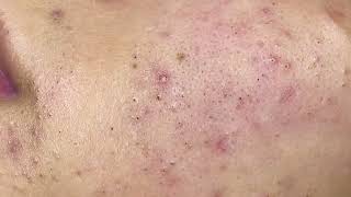 Loan Nguyen Acne Treatment 0976hn [upl. by Griggs]