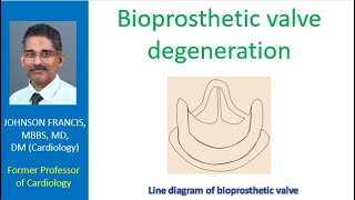 Bioprosthetic valve degeneration [upl. by Annaet]