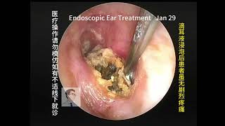 Cleaning of cholesteatoma and ear fungal removal 20240129 [upl. by Sieber]