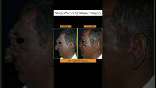 SturgeWeber Syndrome Surgery at GSR [upl. by Darbee141]