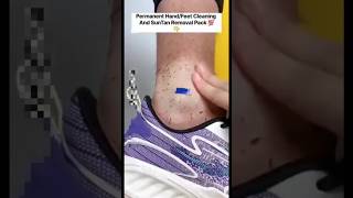 🔥Get Fair Feet  Easy Suntan Removal Pack At Home RemoveSuntan shortsytshortssuntandiyviral [upl. by Hirsch]