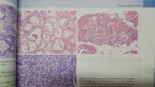 Prostatic Adenocarcinoma  SPECIAL PATHOLOGY [upl. by Socem]