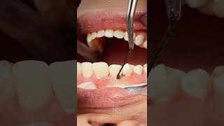 Retraction cord removal after composite veneer dentist dentalprocedure satisfying [upl. by Asserac791]