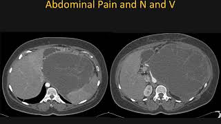 Mucinous Cystic Neoplasm MCN of the Pancreas What You Need to Know – Part 2 [upl. by Hadley]