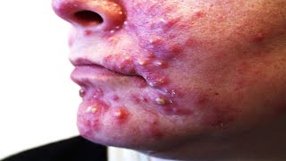 Cystic acne and scarring acne [upl. by Ocinom620]