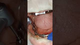 All on 5 for lower jaw with screw retained basalImplants titanium bar fixing video 3rd dayshorts [upl. by Jurgen]