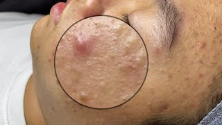 ACNE TREATMENT VU QUYNH MI Acne On Boys Chin 2024 [upl. by Gilcrest]