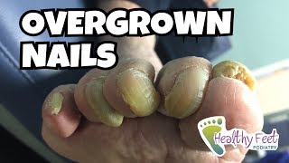 Overgrown Toe Nails [upl. by Hoehne]