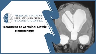 Treatment of Germinal Matrix Hemorrhage [upl. by Dnomder379]