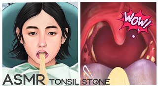 ASMR Tonsil Stone  Satisfying white tongue amp tonsil stones removal  Mengs Stop Motion [upl. by Aisel]