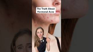 Hormonal Acne Is A Mixed Bag  Heres What You Need To Know dermatologist [upl. by Sivle]