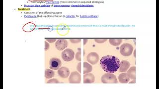 Sideroblastic AnemiaMicrocytic Anemia [upl. by Nissa571]