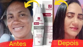 melasma como clareartratamento básico de sucesso pra melasmadermo melan [upl. by Sami]