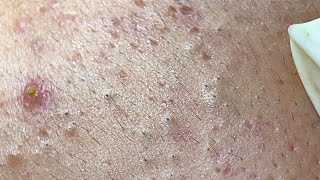 The best acne squeezing collection form Linh Mun Spa part 13 [upl. by Asek224]