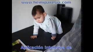 Hemiparesia Infantil  terapia Bobath [upl. by Herzog410]