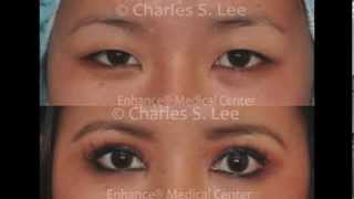 Symmetry ptosis in Asian eyelid surgery by Dr Charles S Lee [upl. by Berte890]