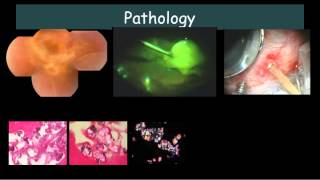 Bilateral Exudative retinal detachment with subretinal exudates Dr E M Dodds [upl. by Alleirbag]