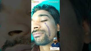 Cat Bite Scar  Scar Removal Surgery  Scar Revision Surgery  Cat Bite  Face Scar [upl. by Millwater]