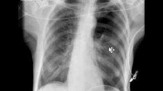 Chest xray pneumothorax [upl. by Mcgrody669]