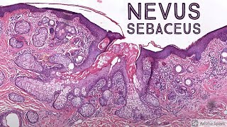 Nevus sebaceus with associated benign hair follicle tumors not spelled quotnevus sebaceOusquot  no O [upl. by Euqilegna]