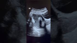 Giant Dermoid Cyst Ultrasound  ovary sonography  ARDMS  obgyn [upl. by Trish]