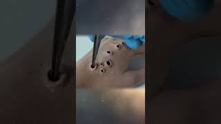 Maggot removal from wound [upl. by Milon]