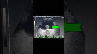 Prostatomegaly  Enlarged Prostate  Median Lobe  Urine Retention on Ultrasound [upl. by Nathan191]