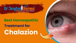 Best Homeopathic Treatment for Chalazion  Dr Singhal Homeo [upl. by Enitsua]