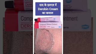 दाद के इलाज़ में Derobin Cream का कमाल Treatment of Ringworm derobin Betnovate tinea luliconazole [upl. by Wakeen]