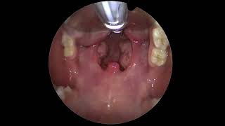 The Throat Exposure For Tonsillectomy Surgery [upl. by Akinirt]