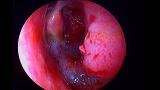 Left inverted papilloma with sinonasal polyposis [upl. by Gavrila104]