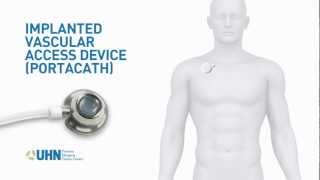 PortaCath Implanted Vascular Access Device [upl. by Jessi]